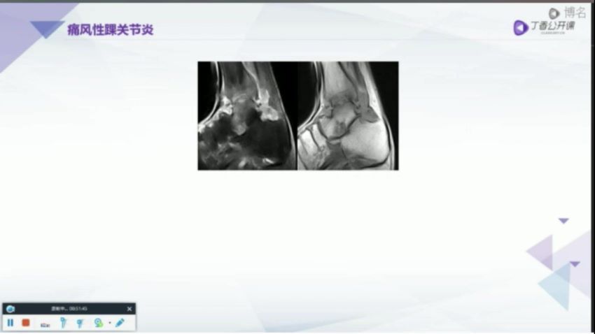 丁香园：骨关节 MRI 全面解读【共12节】【298元】，网盘下载(6.16G)